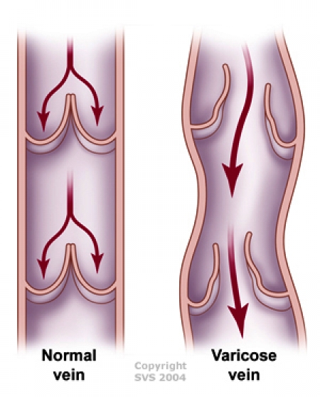 Illustration courtesy of Society for Vascular Surgery