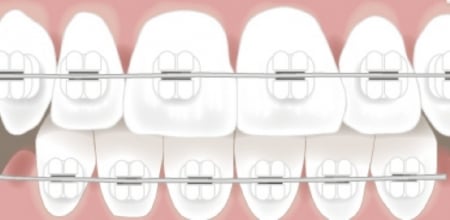 ceramic braces