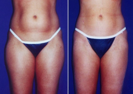 Patients elect to undergo liposuction to remove fat from areas such as the abdomen and thighs, such as in this before photo on the left, but results vary. (Photos courtesy of the American Society of Plastic Surgeons)