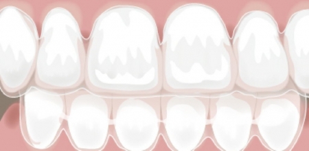 invisible braces