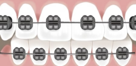 metal braces