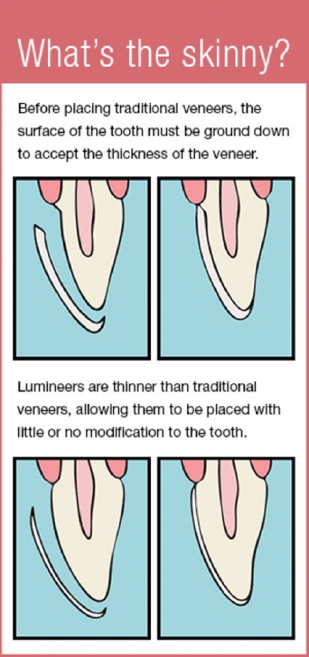 What's the Cost of Lumineers vs. Veneers | Angie's List
