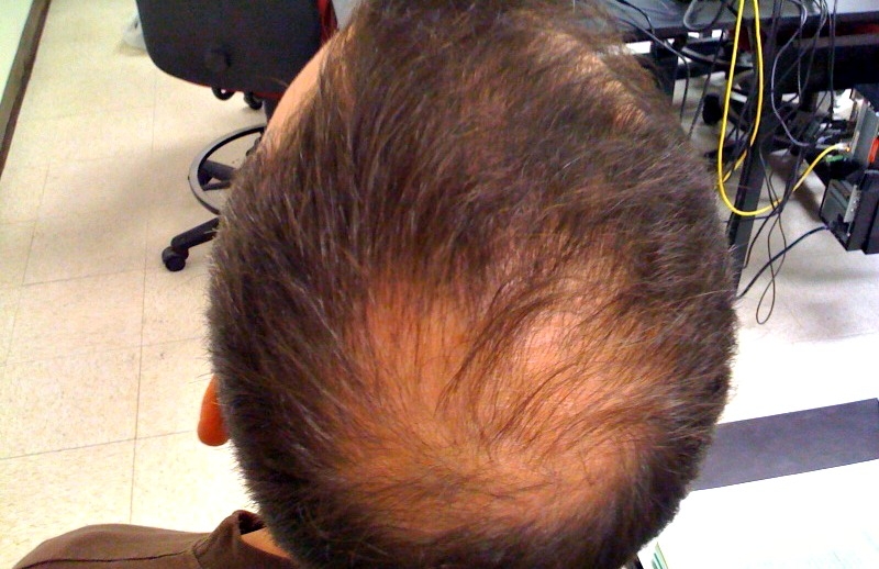 balding head