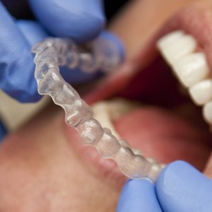 Is It Worth The Cost To Fix Gap Teeth Angie S List Invisalign Braces