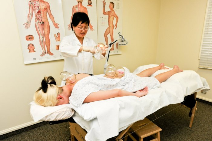 Cupping Therapy