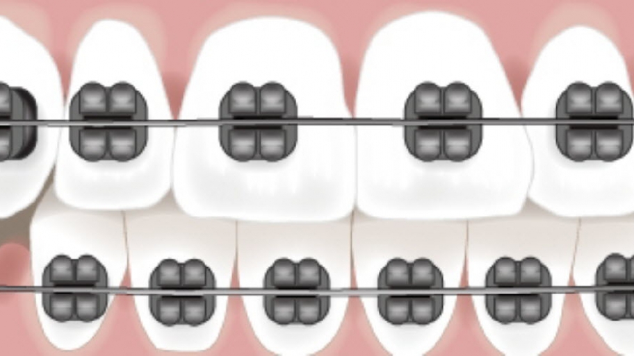 braces on teeth