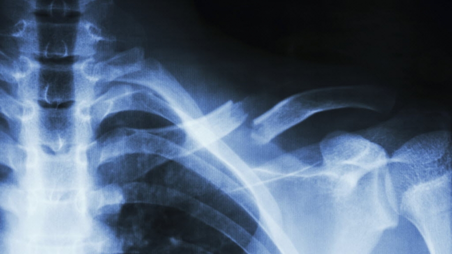 X-ray of a broken collarbone