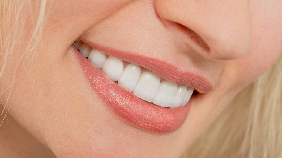 a woman with porcelain veneers
