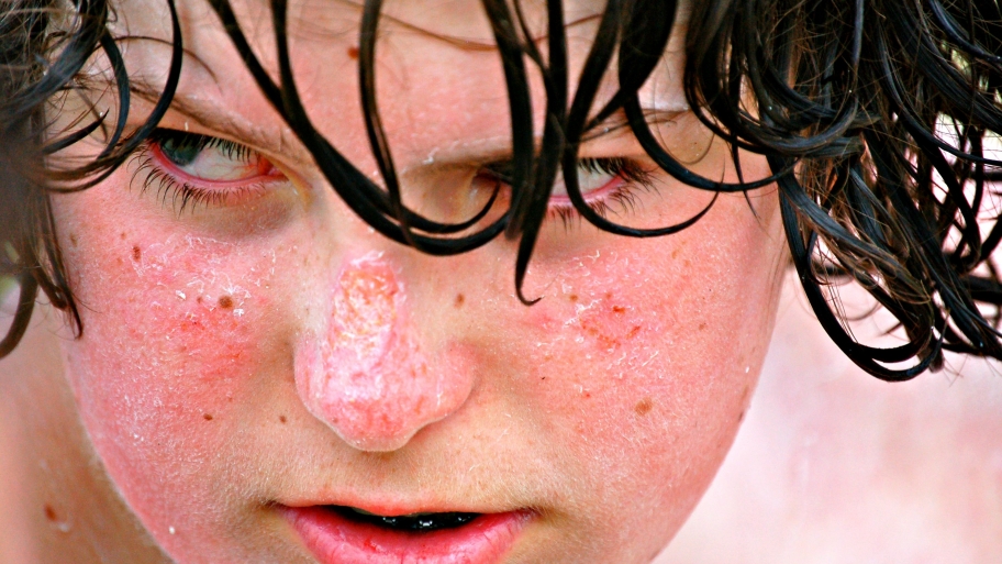 child's sunburned face