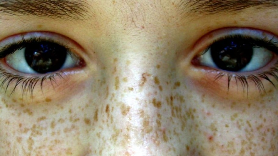 kids with freckles