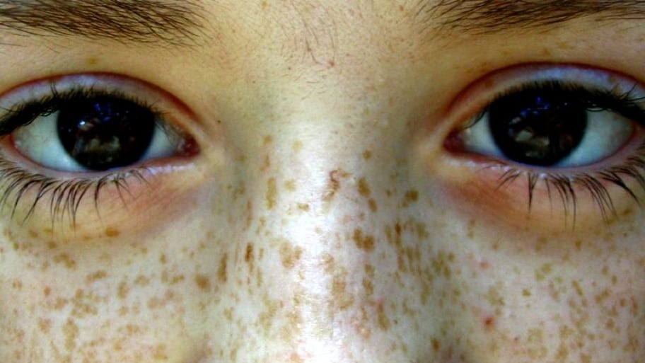 Diy And Expert Tips To Get Rid Of Freckles Angies List - 