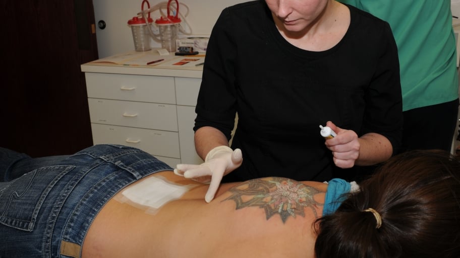using ointment on back for laser tattoo removal