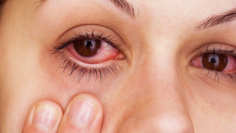 pink eye