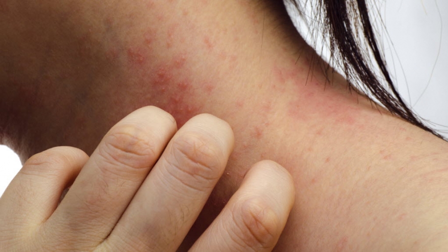 a person scratches a rash on their neck.