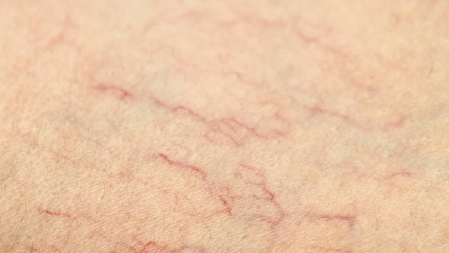 closeup of red veins lines on skin