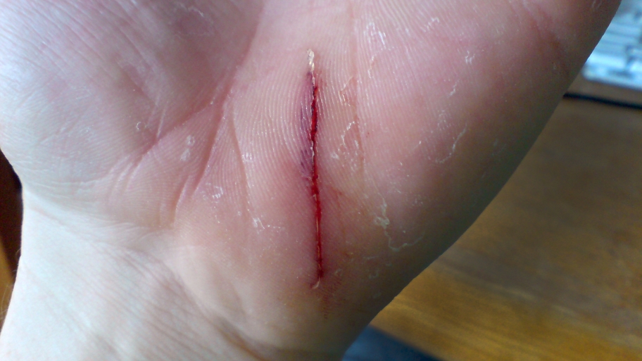hand with deep cut