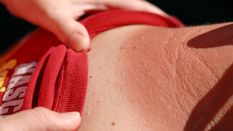 fingers pulling down shirt to show sunburned skin on neck