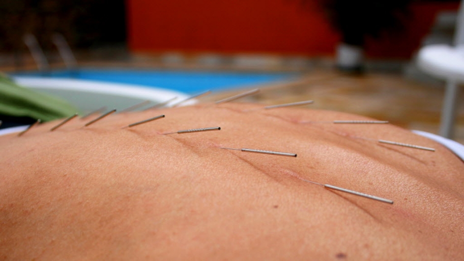 acupuncture session