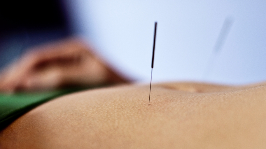 acupuncture needle in a back