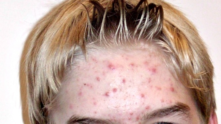 acne on forehead