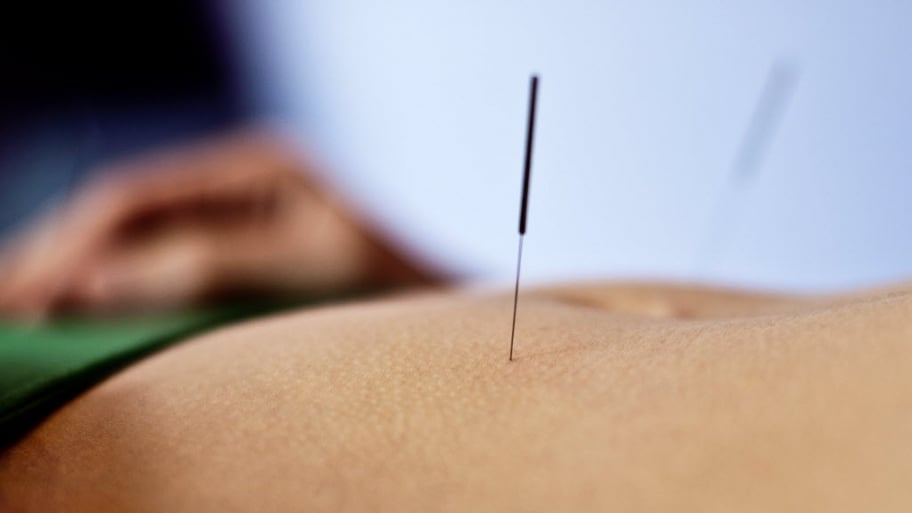 Acupuncture treatment