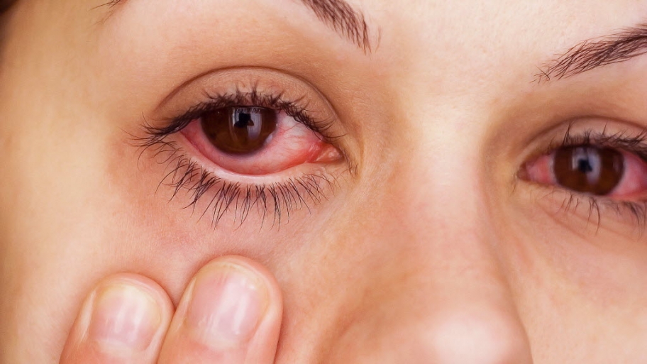 Red, sick eyes