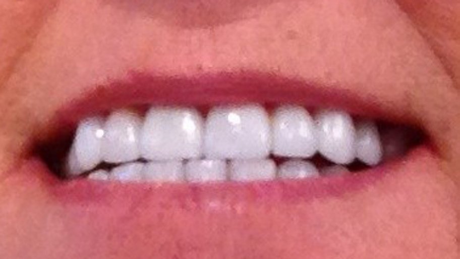 Is Dental Insurance Worth The Cost Angie S List