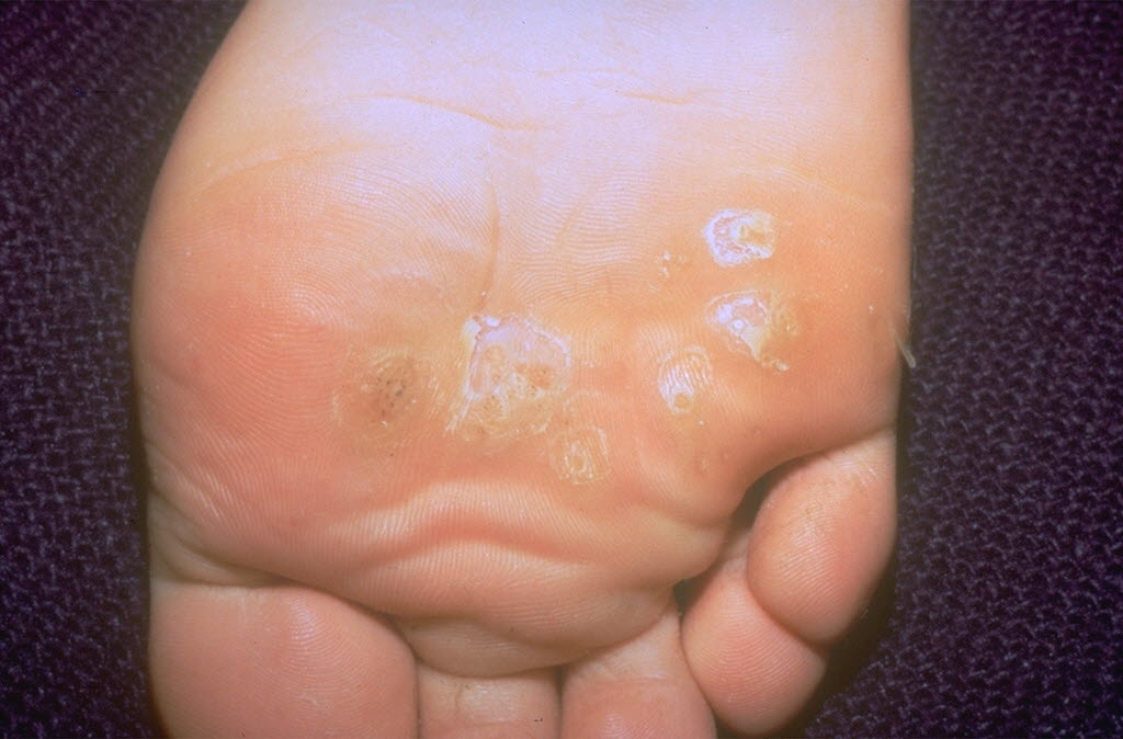 Planters Wart On Child S Hand Bruin Blog