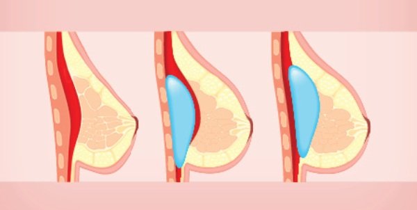illlustration of breast augmentation