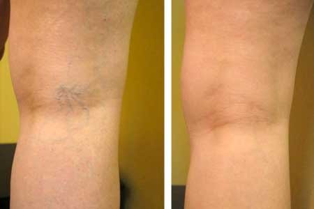 Visible veins, such as spider and varicose, can often be treated with compression socks and lifestyle changes, or can disappear with the help of laser treatments or vein stripping surgery. (Photo courtesy of Angie's List member Alice O. of Redmond, Washington)