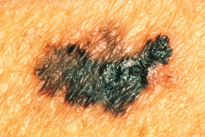 asymmetrical mole