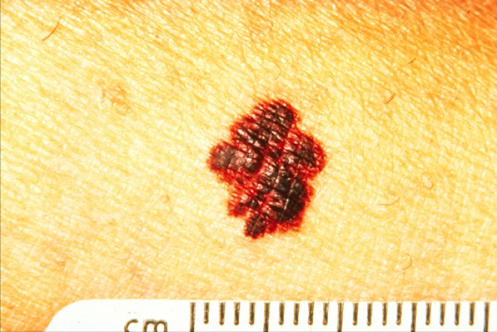melanoma with ragged edge