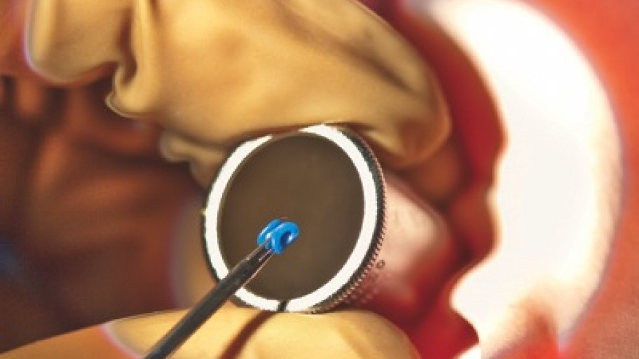 Indianapolis Doctors Urge Discretion When Placing Ear Tubes in Children