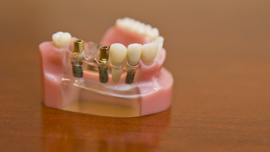dental implants shown side by side with teeth