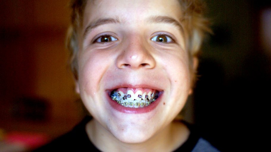 A boy showing off his the braces on his teeth