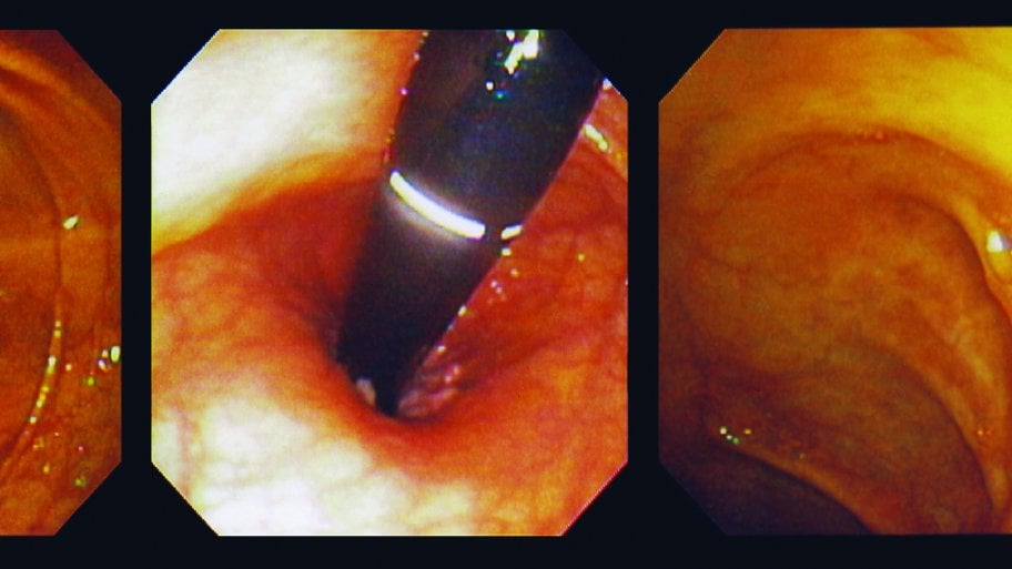 three photo views of the Interior of a human colon