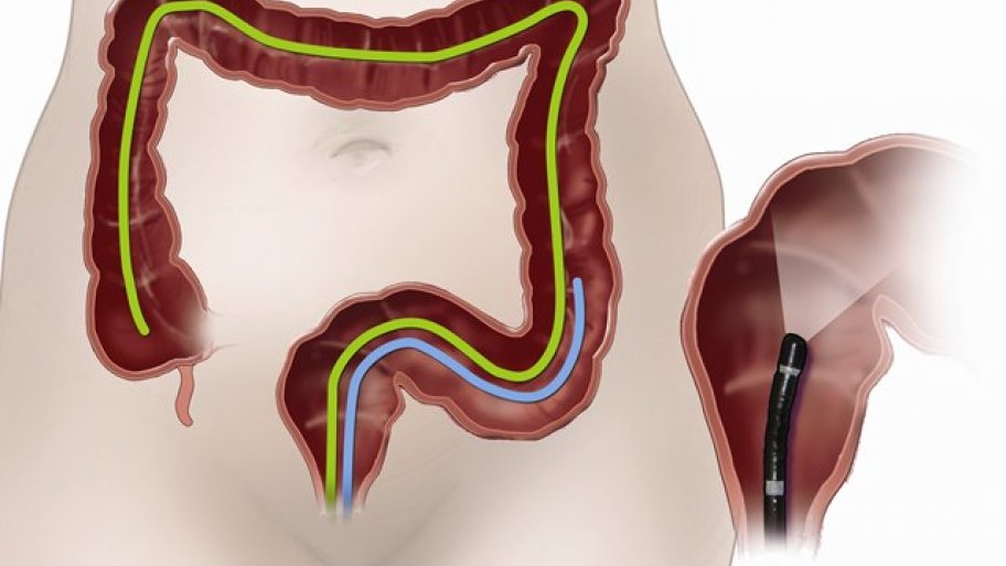 Colonoscopy illustration