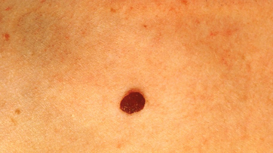 normal looking mole
